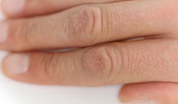  How To Take Care of Dry, Cracked Hands and Nails
